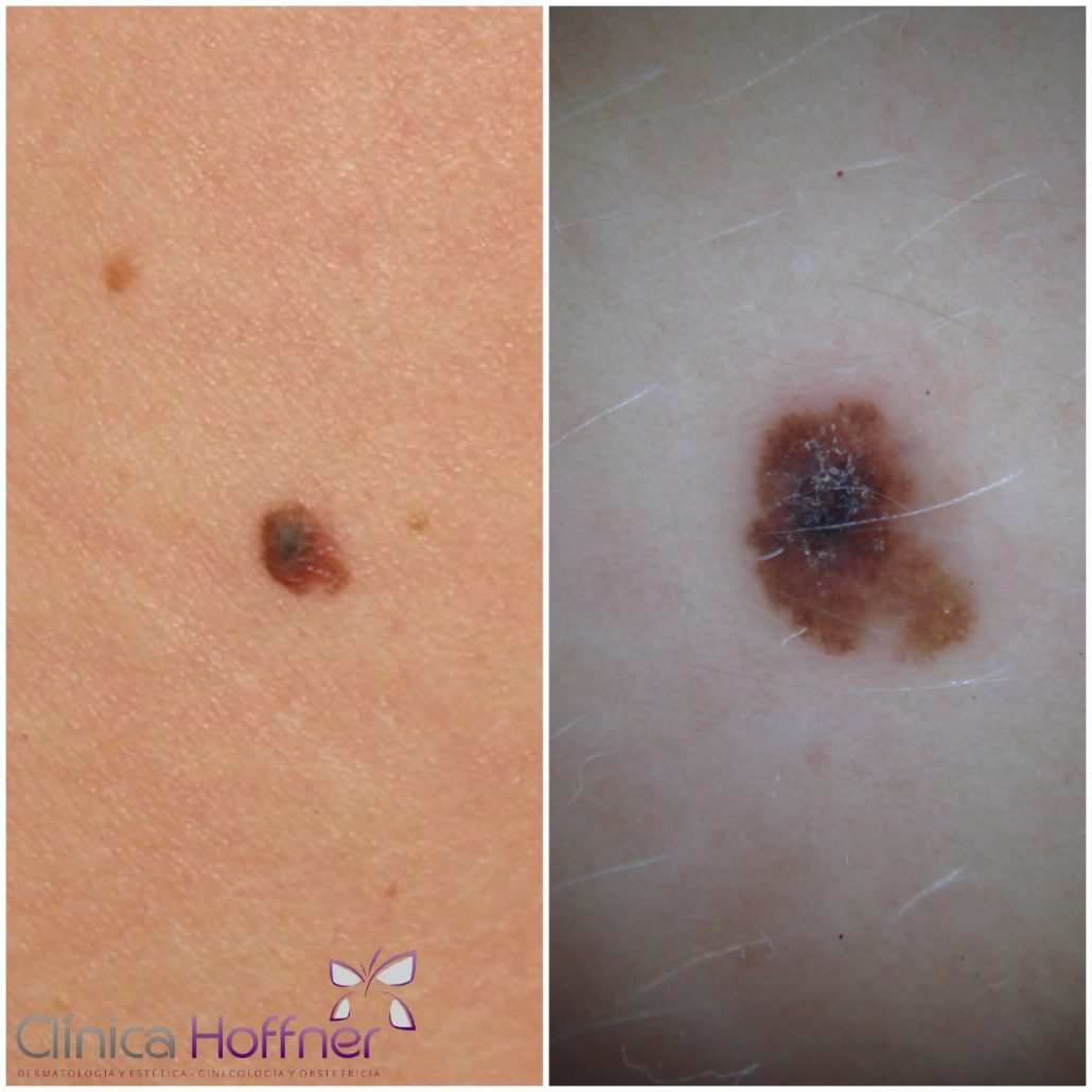 Imagen clinica y dermatoscopica de un melanoma