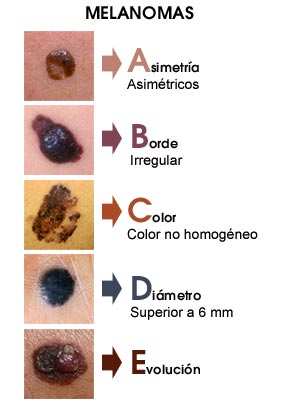 Regla ABCDE del melanoma