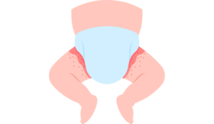 Dermatitis del pañal