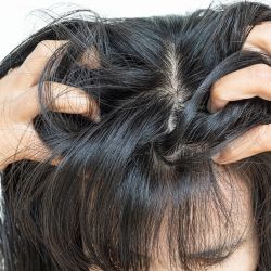 picor cuero cabelludo